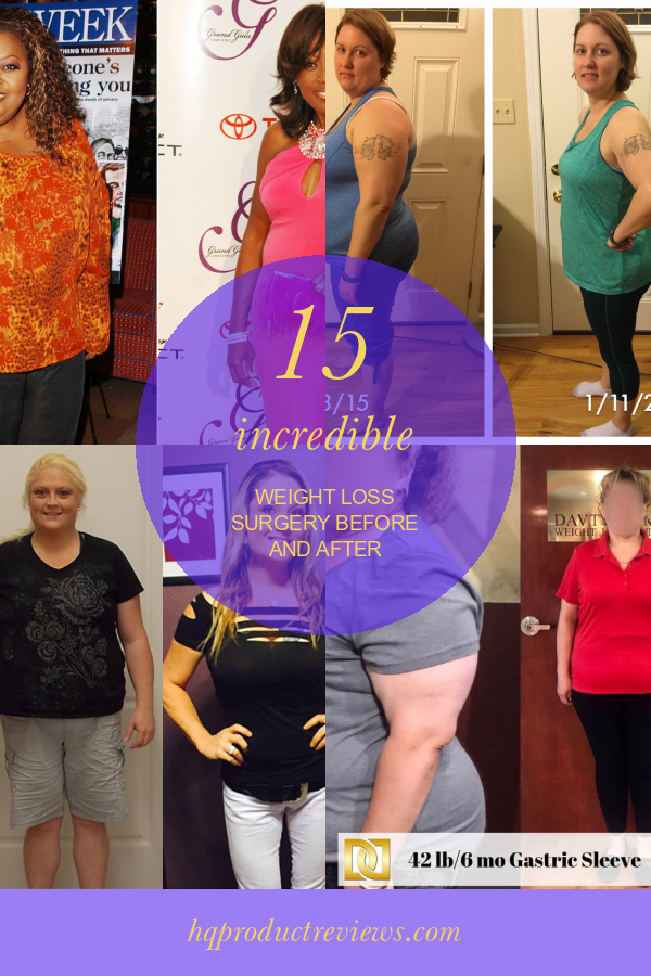 15 Incredible Weight Loss Surgery before and after Best Product Reviews